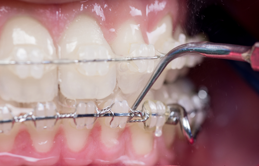 Czwarta wizyta u ortodonty - kontrolna